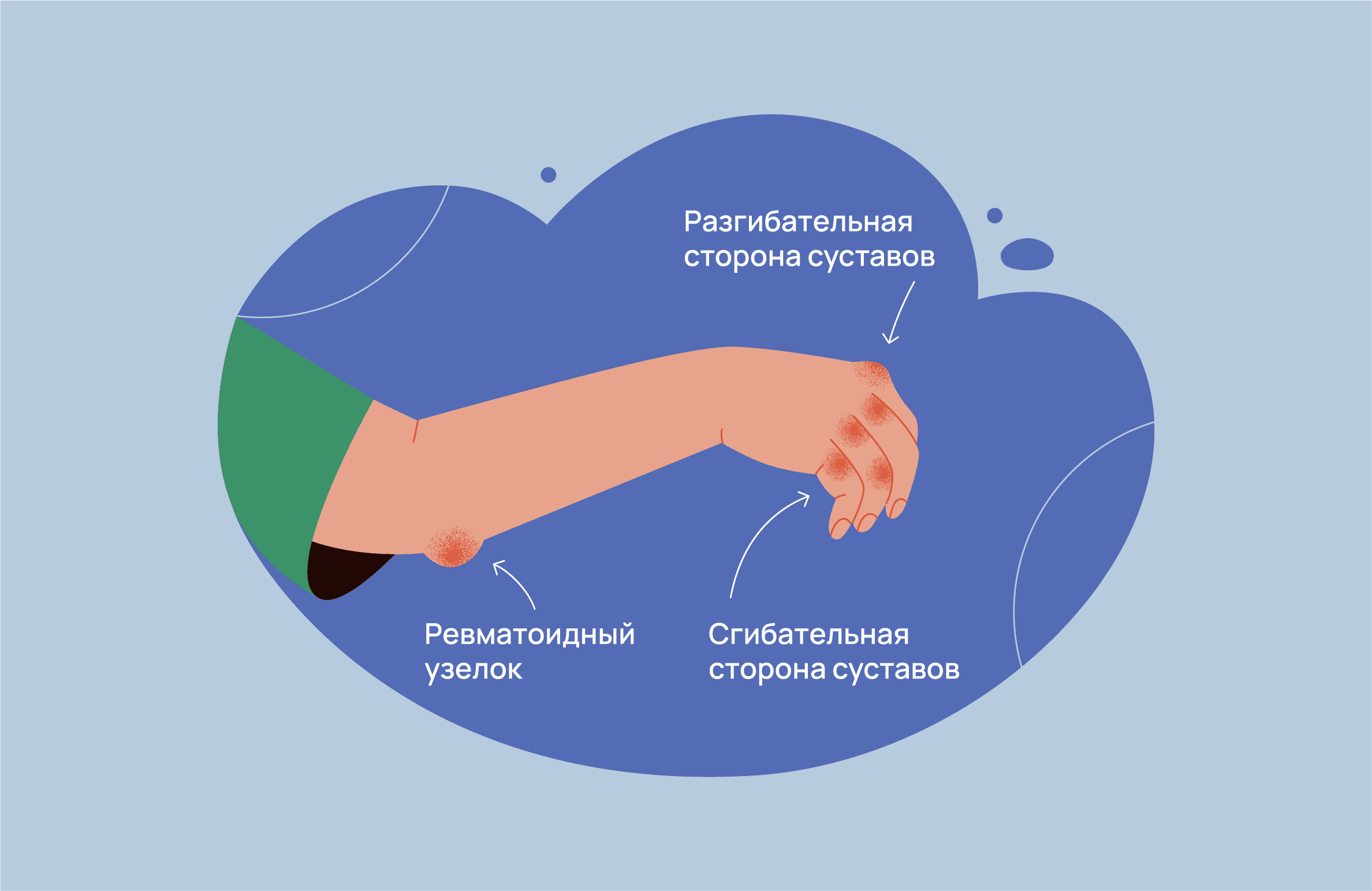 Ревматоидные узелки при РА: почему появляются и что с ними делают