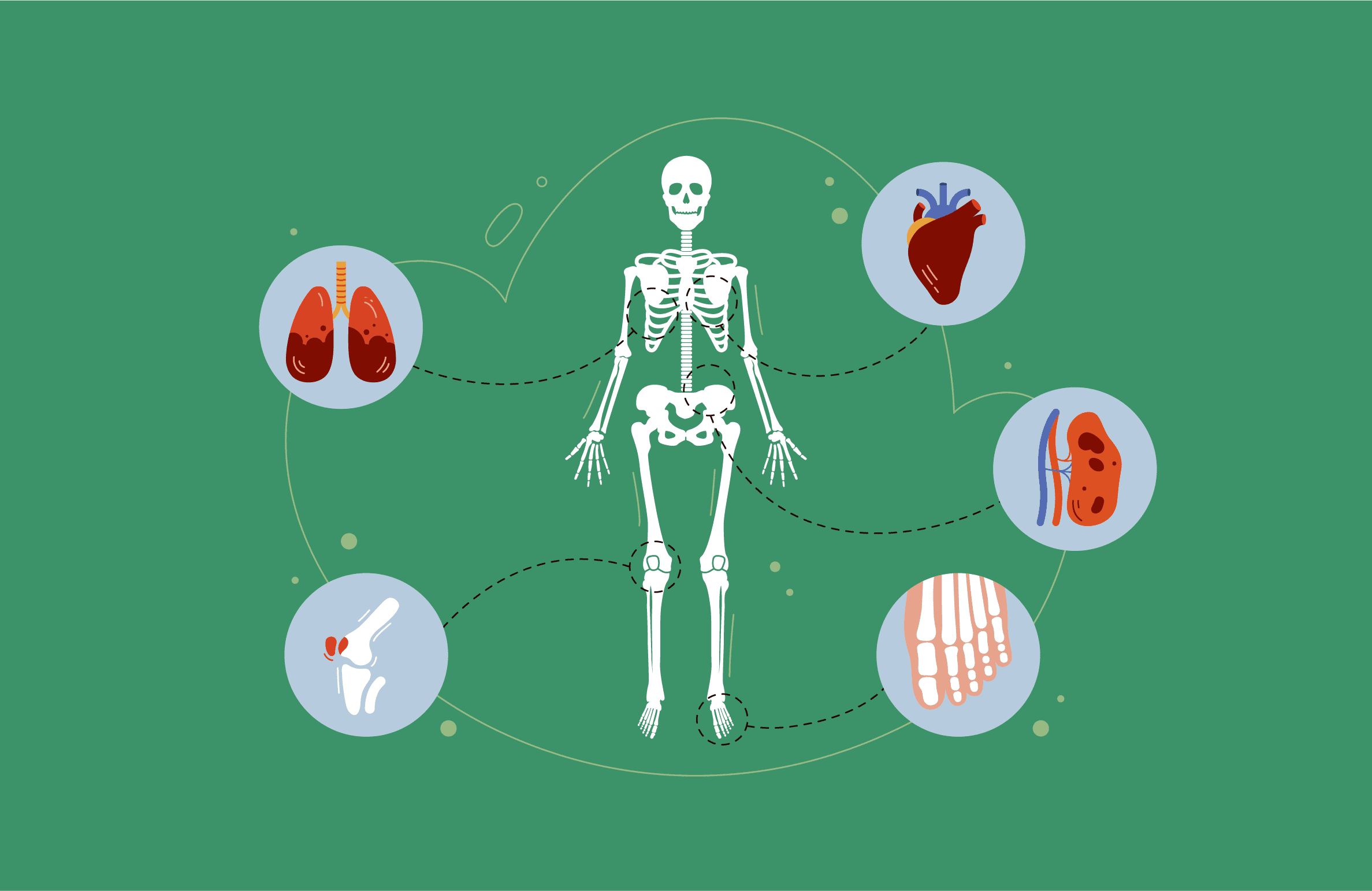 Осложнения ревматоидного артрита
