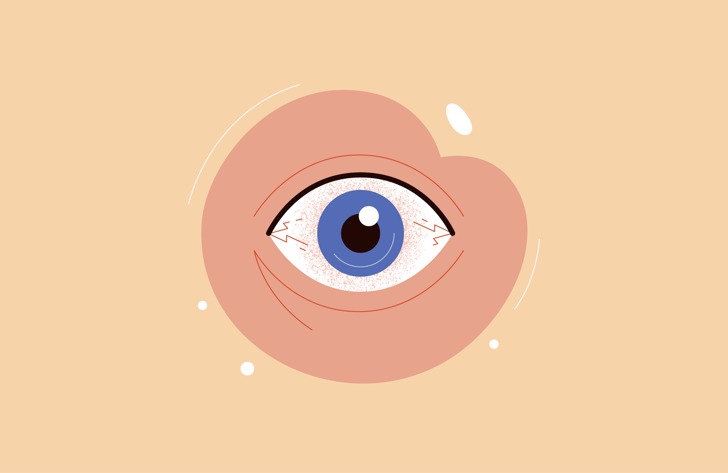 Псориатический артрит и болезни глаз