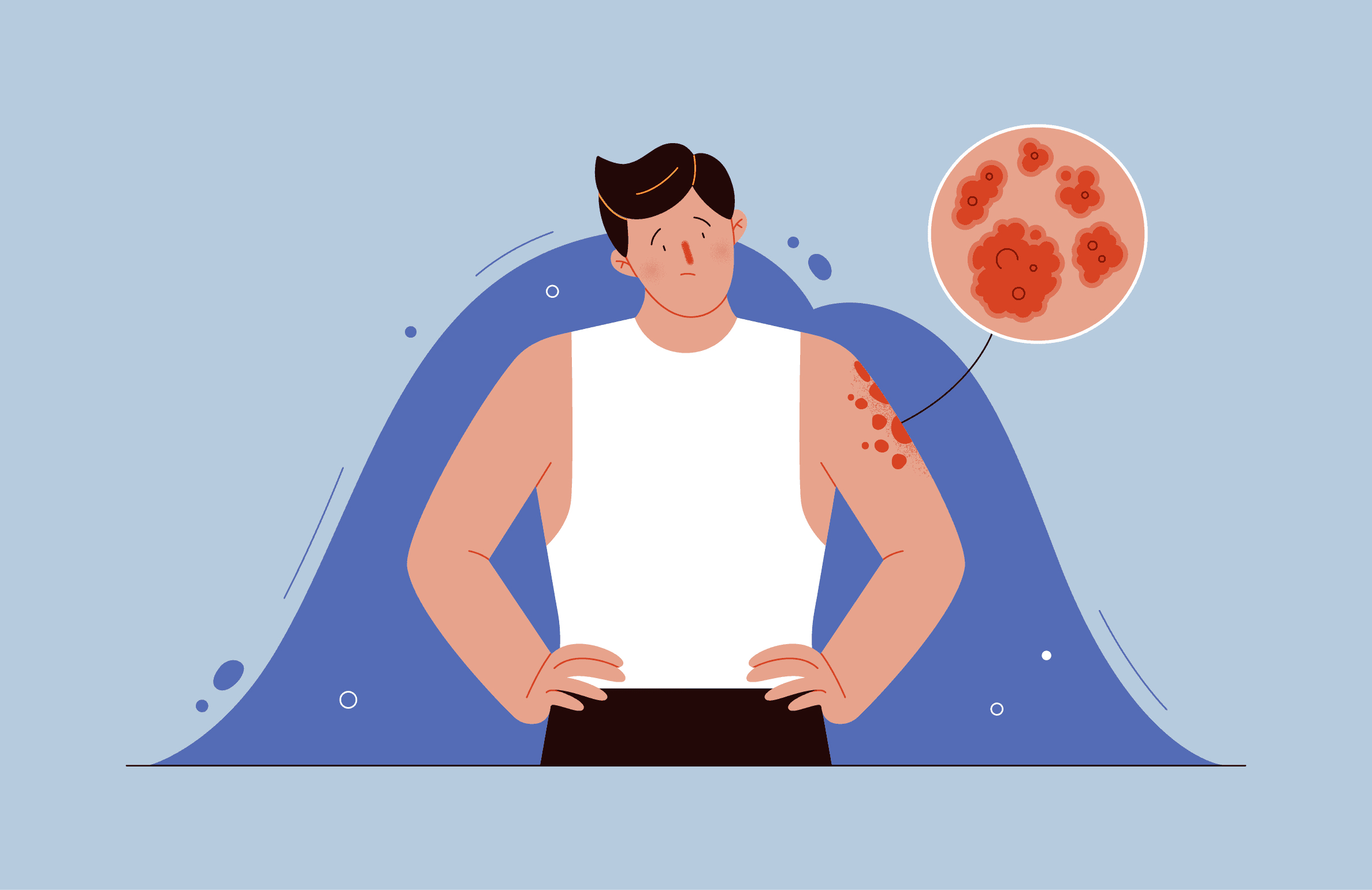 Псориаз при псориатическом артрите: чем лечить и как помочь себе