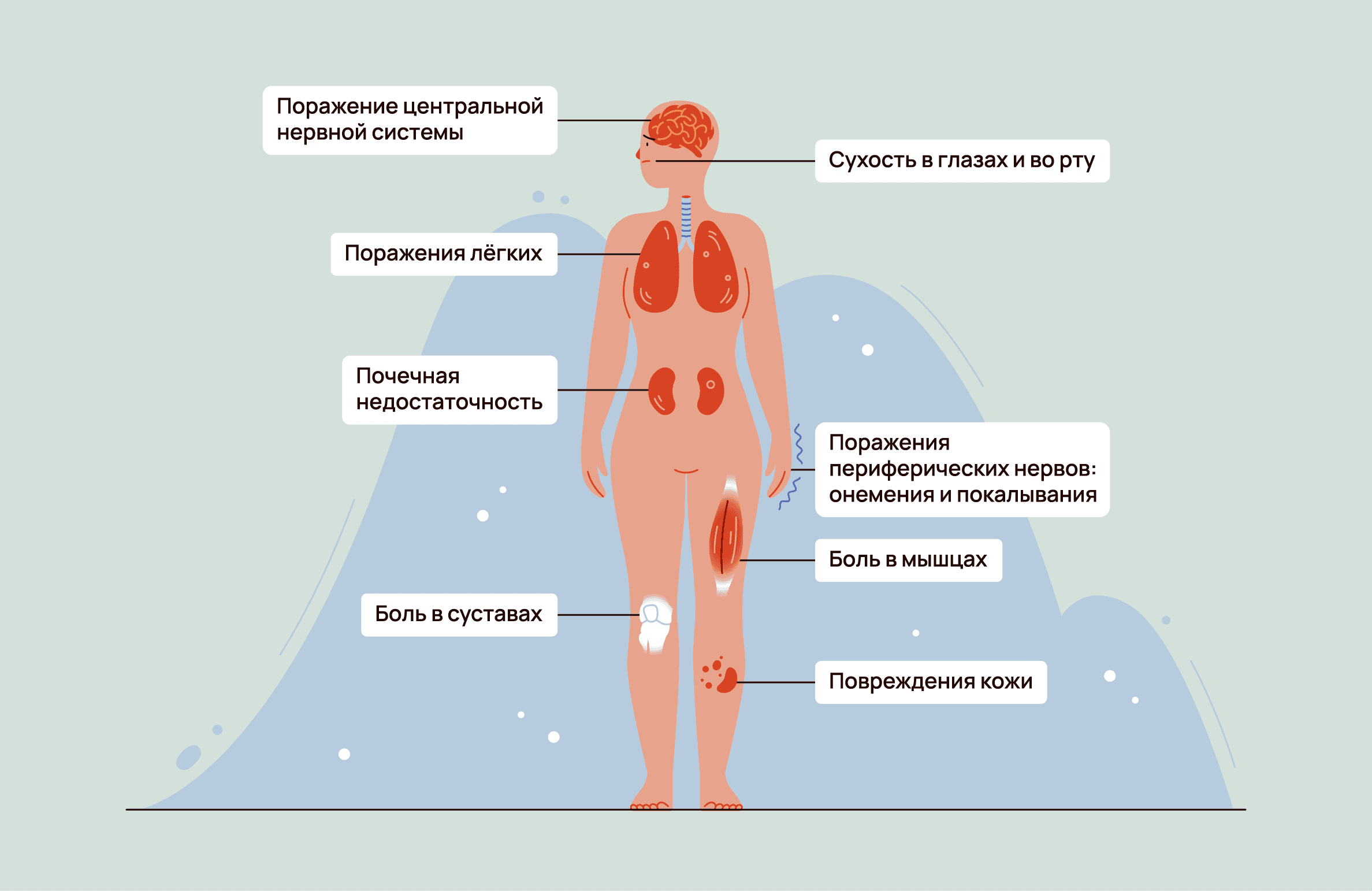 Синдром Шегрена при РА