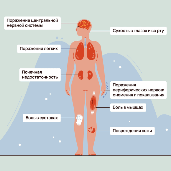 Синдром Шегрена при РА