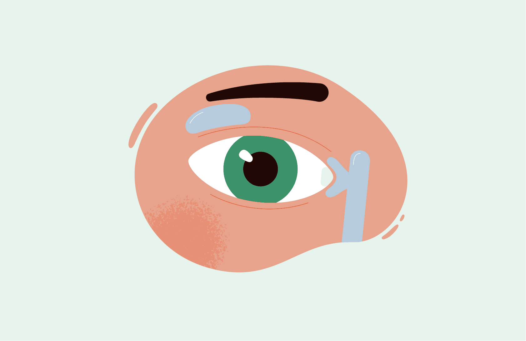 Синдром Шегрена при аксиальном спондилоартрите